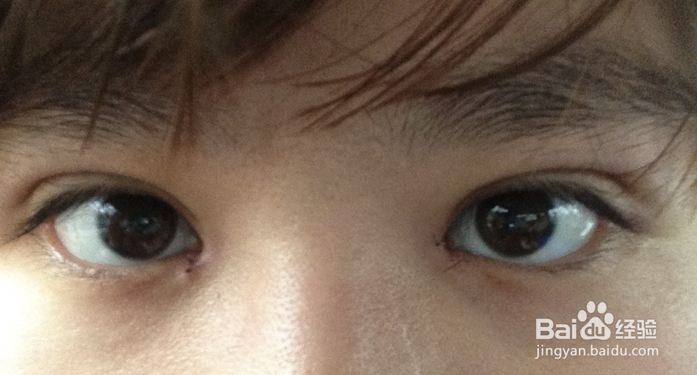 开眼角后常常无刺激下流眼泪怎么办？