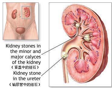 怎样用偏方治疗肾结石