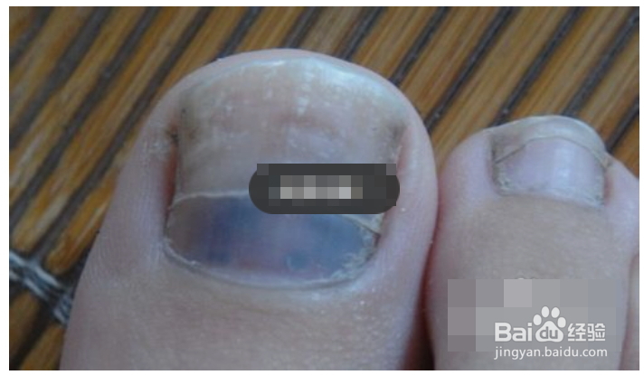 脚趾甲发白|是怎么回事|要怎么办