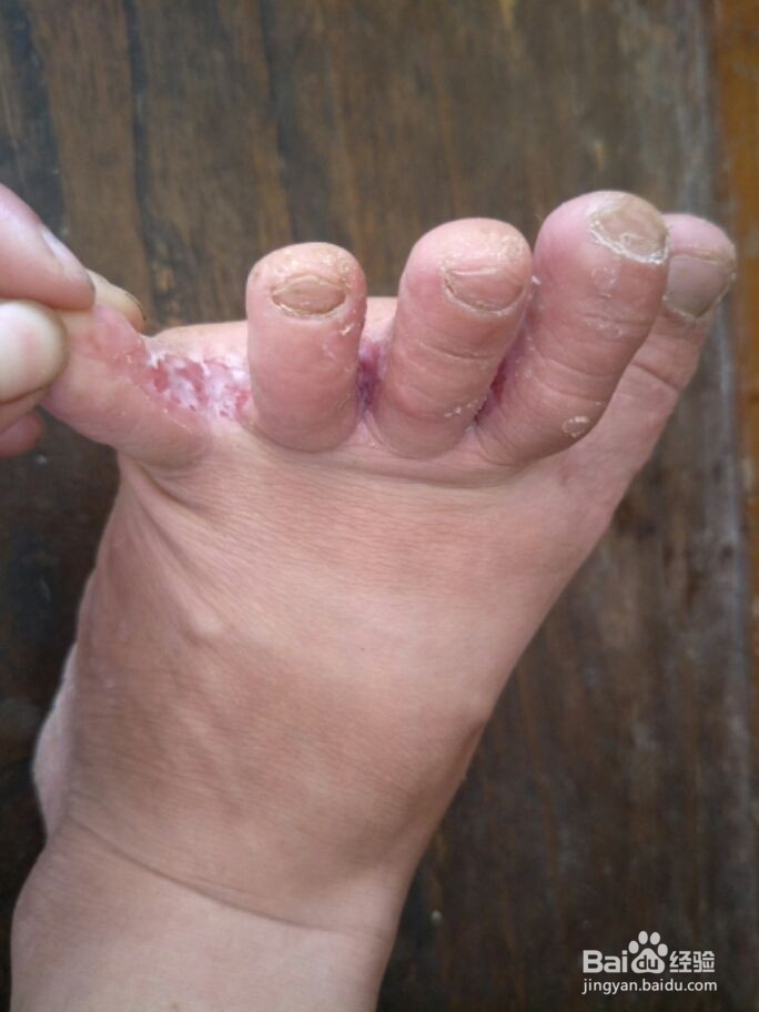 脚臭是怎么回事?教你4个方法解决它