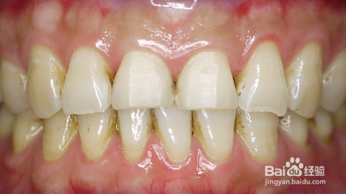 牙齿贴面的优势