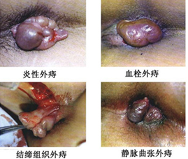 外痔疮的症状有哪些