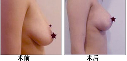 乳房下垂矫正