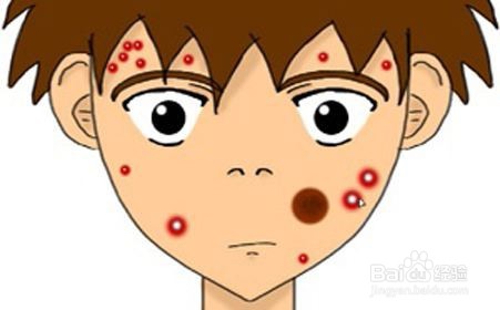 青春期孩子长痘怎么办