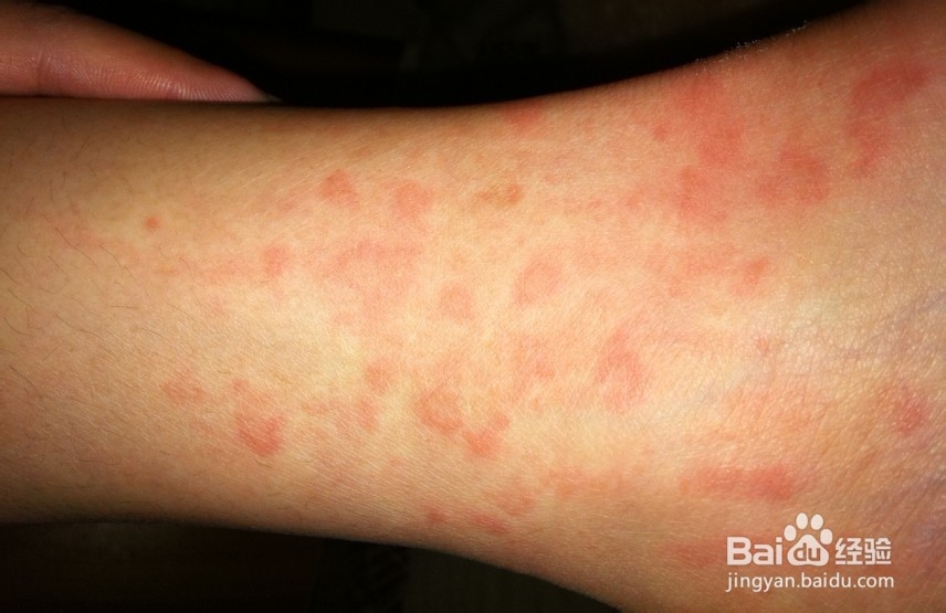 怎样判断你的体内是否有湿气