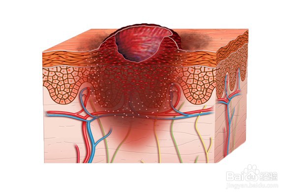 治疗褥疮最好的中医方法