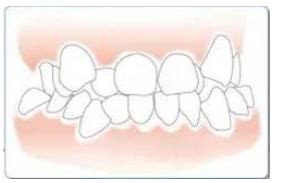 矫正牙齿的错误认识