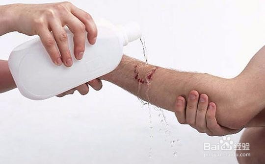 被狗咬了怎么办，这几个常识必懂！