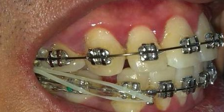 南宁牙齿矫正橡皮圈的作用有哪些？