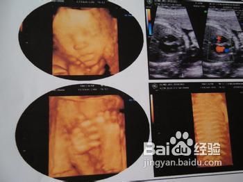 为什么要做超声心动图?