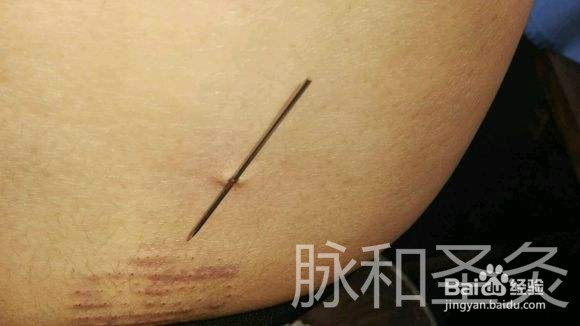 挑刺疗法的挑刺步骤有哪些