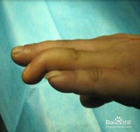 手指弯不回来了伸不直了，肌腱轻微断裂