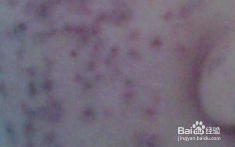 学生祛斑最快最好方法/初中生雀斑能去掉吗