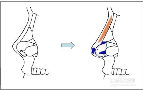 鼻综合术后注意事项