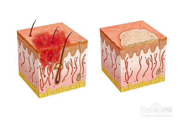 治疗褥疮最好的中医方法