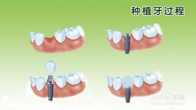 种植牙的利与弊
