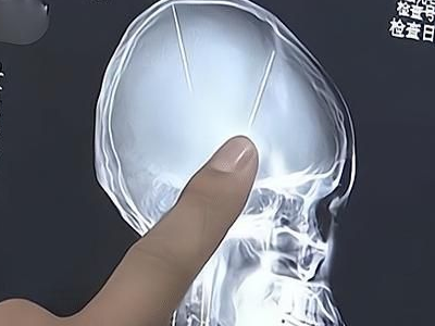 遇车祸才发现头部有两根针已存在多年，究竟是什么情况