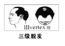 男性流花植发有哪些优点和特点?