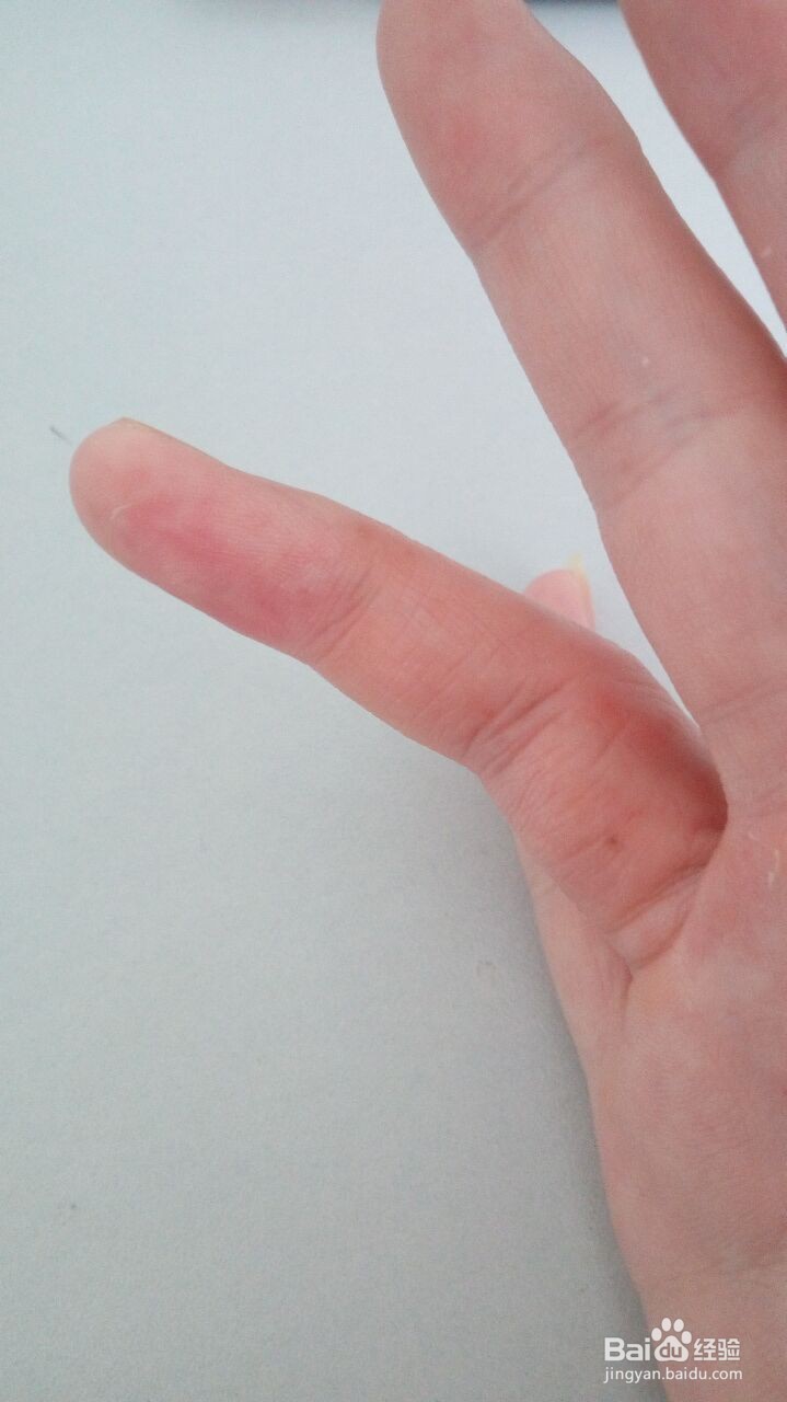 手指小水泡的治疗过程（真实经验）