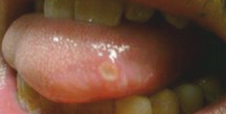 口腔溃疡病因分解与治疗