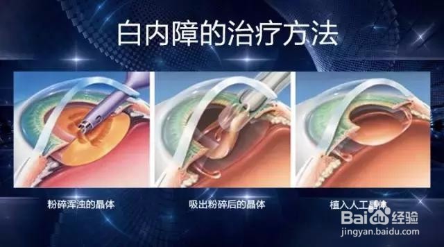 关于白内障你应该了解的5件事