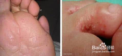 足癣图片大全 百度经验
