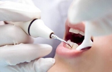 洗牙应该怎么洗才好