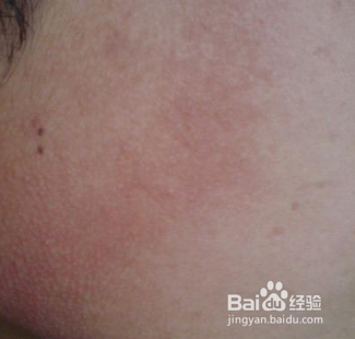 黑斑要怎么去除