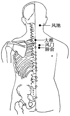 百病刮痧：[9]感冒的刮痧疗法