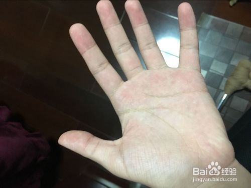 手部干燥粗糙的原因和缓解方法 百度经验