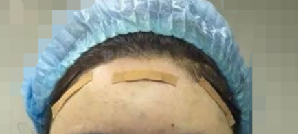 什么是填脂肪、自体脂肪填充大约需要多少钱？