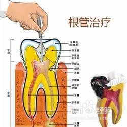 根管治疗虫牙全过程是怎么样的？