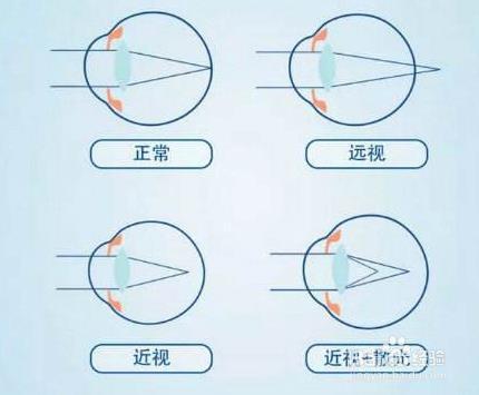 散光的症状是什么？