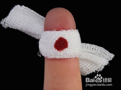 外出血的止血方法