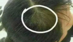 头发脱落严重怎么办