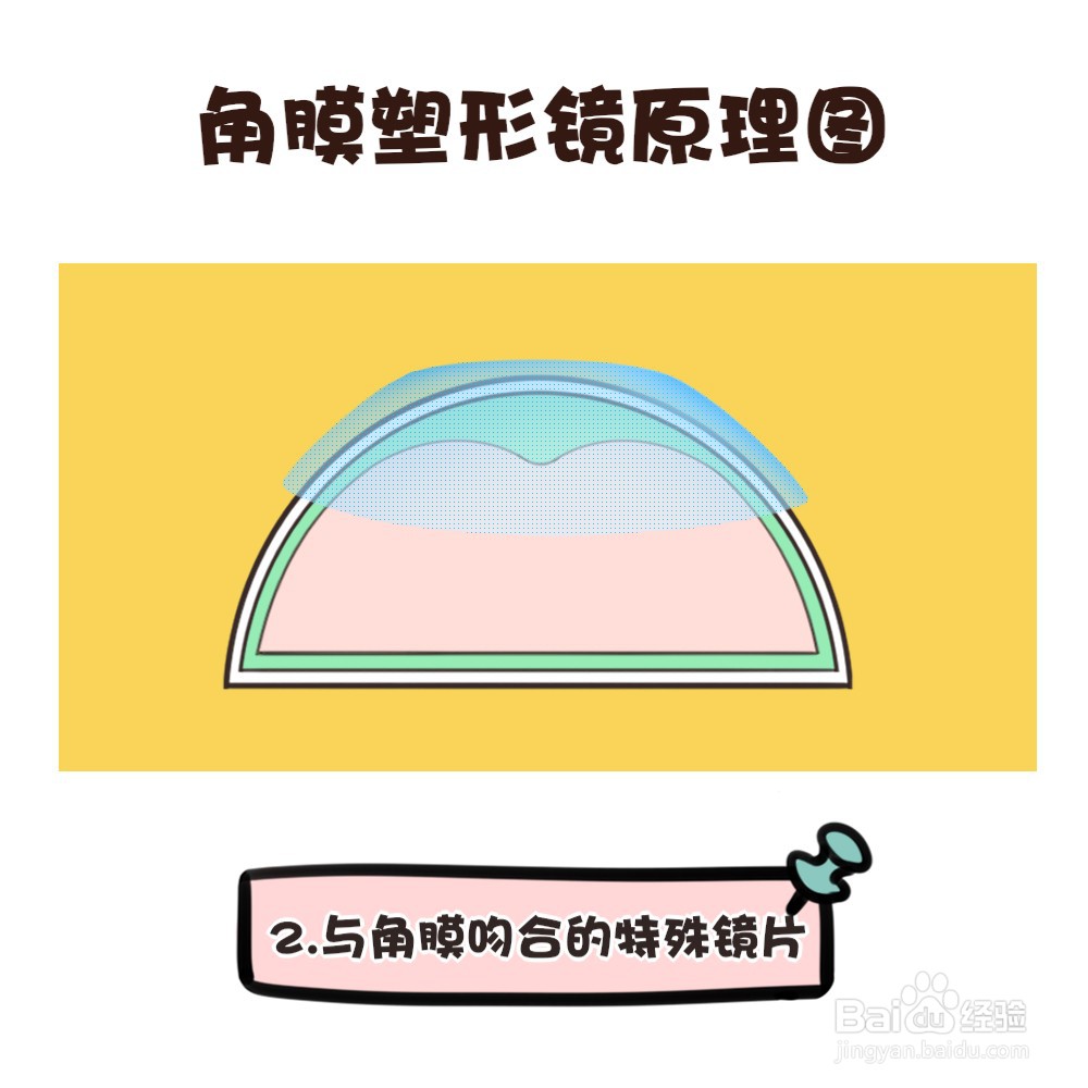 角膜塑形镜的原理