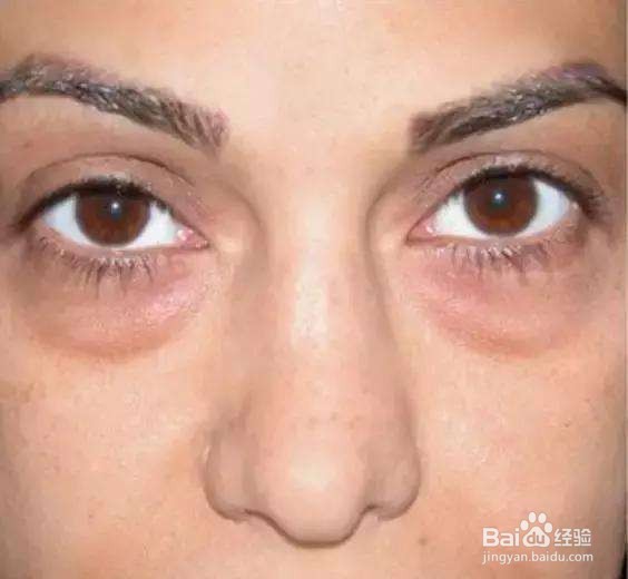 眼袋怎样去除好