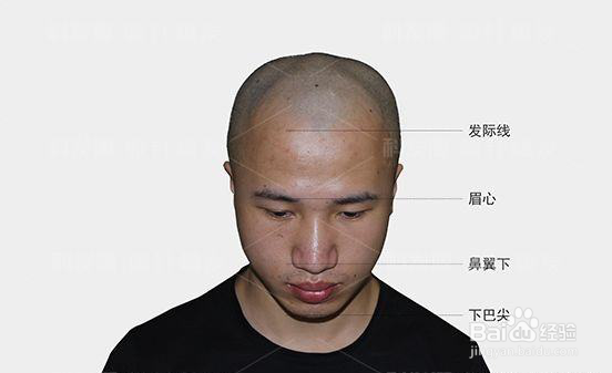 鬓角种植前怎么做不会留下疤痕