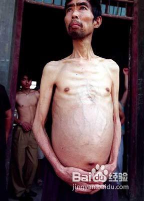 人突然消瘦的原因