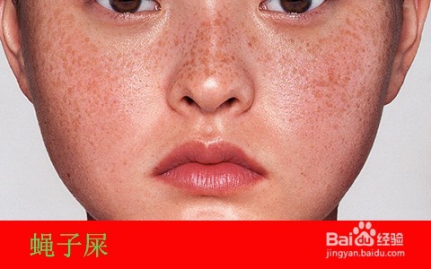 脸上有苍蝇屎怎么去除/最简单去蝇子屎方法