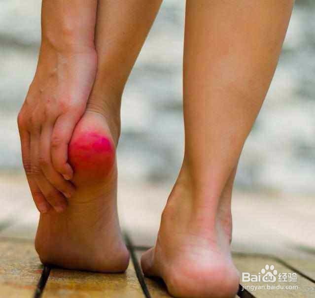 脚后跟疼该怎么治