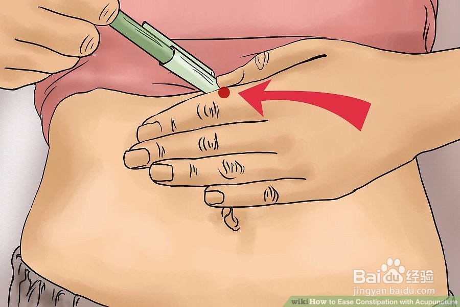 如何用针灸缓解便秘