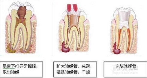 牙齿根管治疗后，为何还痛？