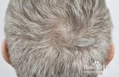 为何年纪轻轻就白发？赶紧看看什么原因吧！