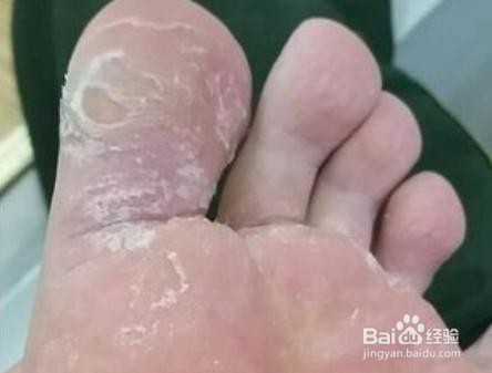 如何防止起皮？