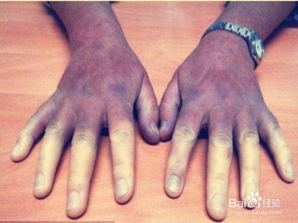 教你辨别“危险的”手脚冰凉