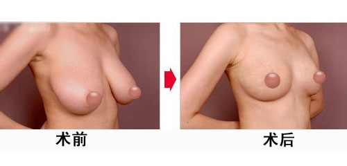 乳房下垂矫正