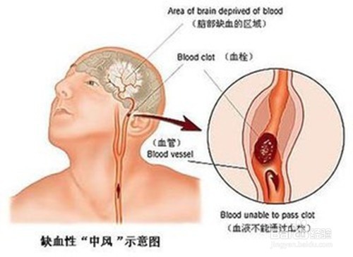 小中风怎样预防，降低发展为大中风的风险