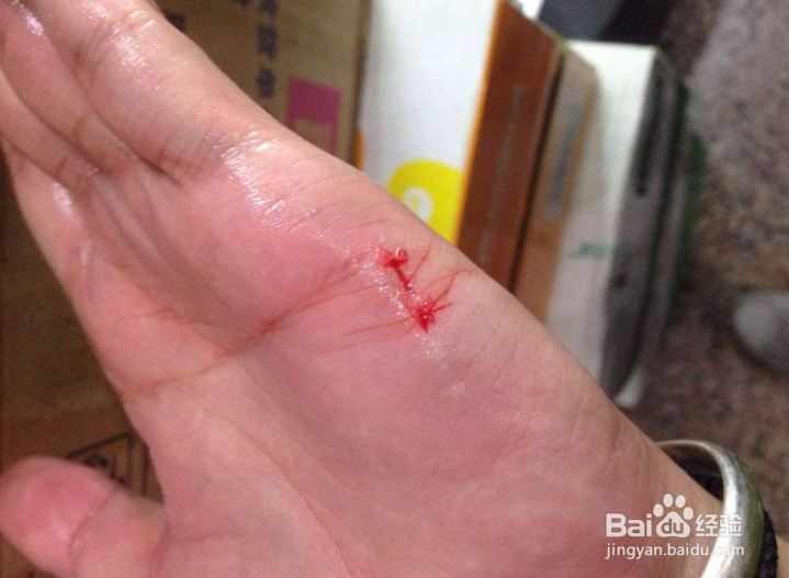 被猫抓伤后该怎么办？