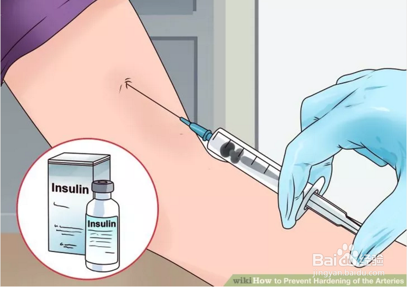 如何防止血管硬化